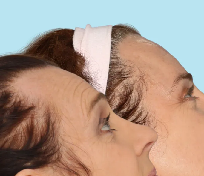 Una línea de cabello masculina antes de someterse a la cirugía de feminización de la línea de cabello y el resultado de una línea de cabello más femenina después de la cirugía de reducción de la línea de cabello.