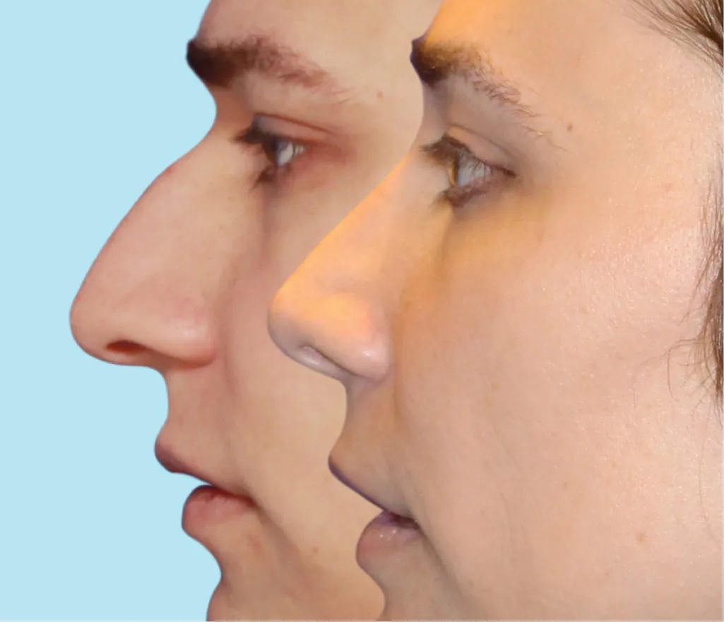 Una nariz masculina antes de someterse a la cirugía de feminización de la nariz y el resultado de una nariz más femenina después de la cirugía FFS de la nariz.