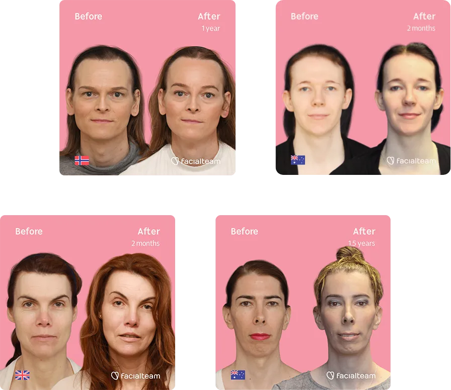 Recopilación de 4 pacientes de Facialteam FFS que muestran el resultado del antes y el después de su cirugía de feminización facial
