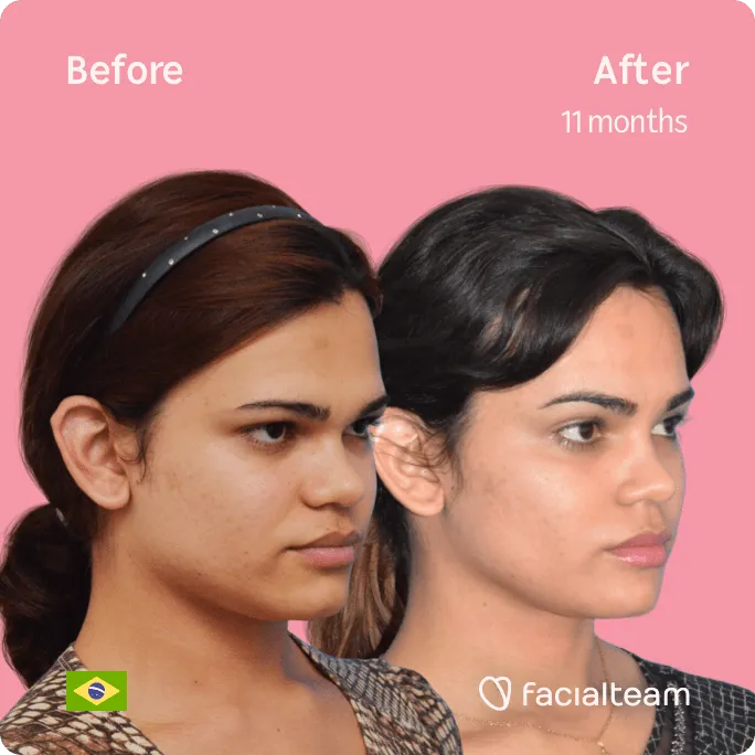 Square 45 degree image of FFS patient Aline showing the results before and after facial feminization surgery consisting of forehead, jaw and chin feminization surgery.