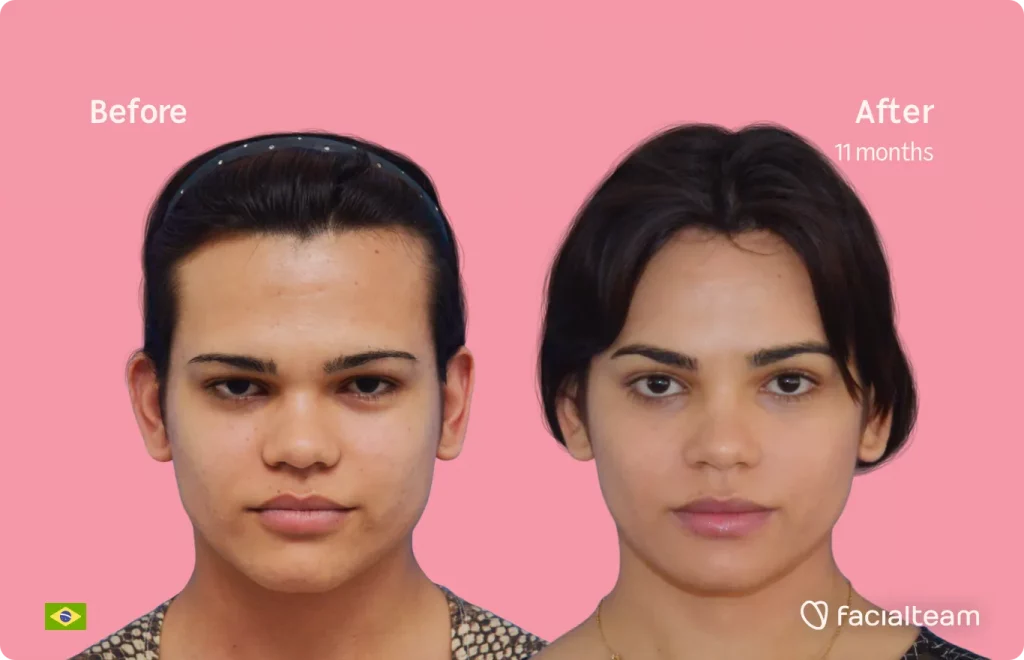 Frontal image of FFS patient Aline showing the results before and after facial feminization surgery with Facialteam consisting of forehead, jaw and chin feminization surgery.