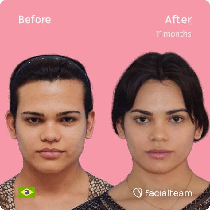 Square frontal image of FFS patient Aline showing the results before and after facial feminization surgery with Facialteam consisting of forehead, jaw and chin feminization surgery.
