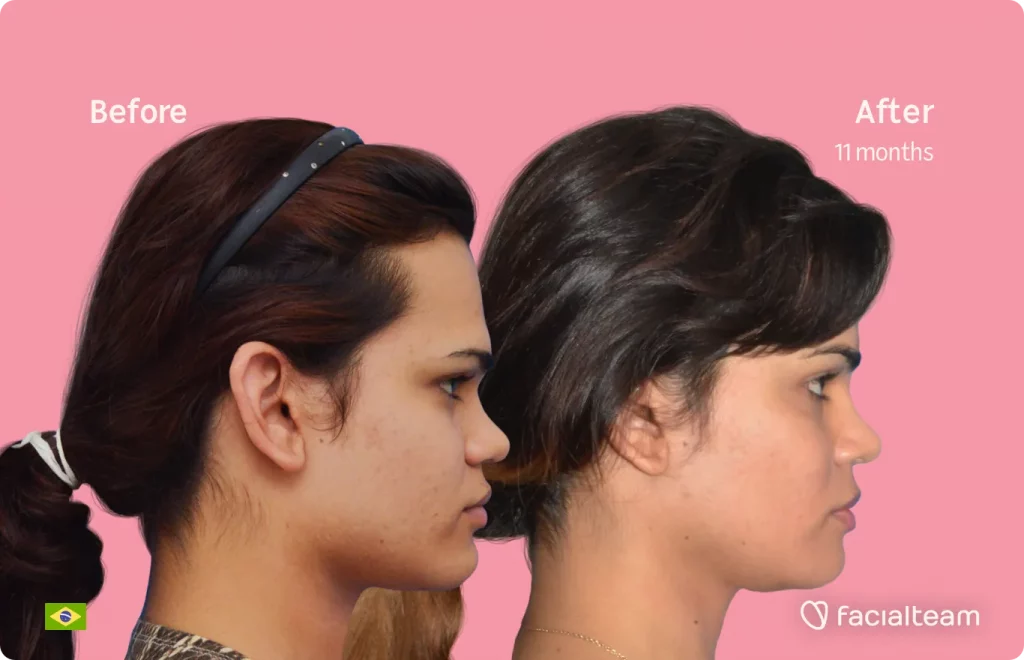 Side image of FFS patient Aline showing the results before and after facial feminization surgery with Facialteam consisting of forehead, jaw and chin feminization surgery.
