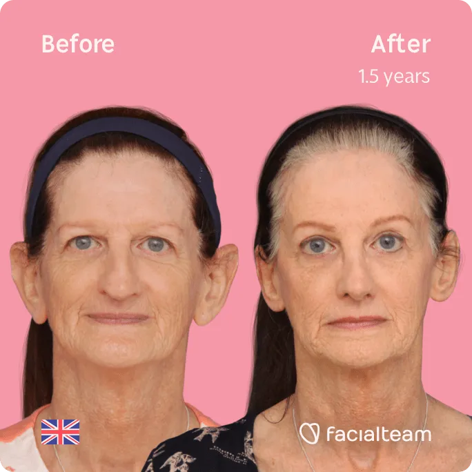 Square frontal image of FFS patient Jacqueline L showing the results before and after facial feminization surgery with Facialteam consisting of forehead, jaw and chin feminization surgery.