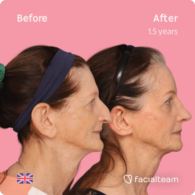 Square Side image of FFS patient Jacqueline L showing the results before and after facial feminization surgery with Facialteam consisting of forehead, jaw and chin feminization surgery.