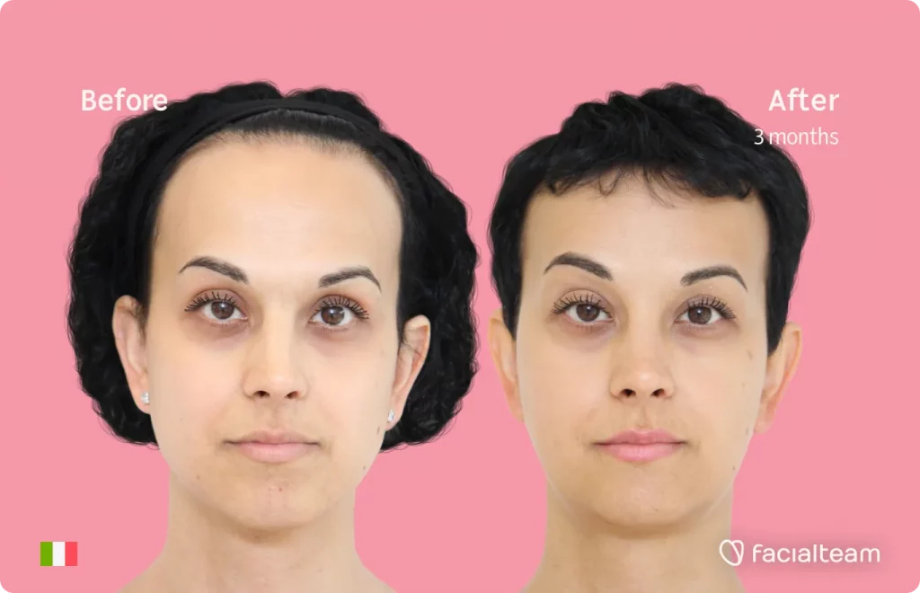 Imagen frontal de Lory, paciente de Cirugía de Feminización Facial, que muestra los resultados antes y después de la cirugía de feminización facial con Facialteam, que consiste en una cirugía de feminización de la frente, la mandíbula y el mentón.