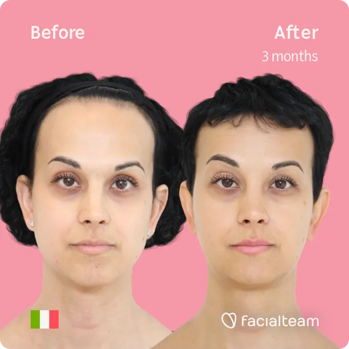 Imagen frontal cuadrada de Lory, paciente de Cirugía de Feminización Facial, que muestra los resultados antes y después de la cirugía de feminización facial con Facialteam, que consiste en una cirugía de feminización de la frente, la mandíbula y el mentón.