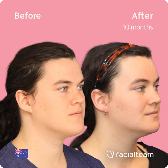 Imagen cuadrada de 45 grados de la paciente FFS Winter que muestra los resultados antes y después de la cirugía de feminización facial que consiste en la cirugía de feminización de la frente, la mandíbula y el mentón.
