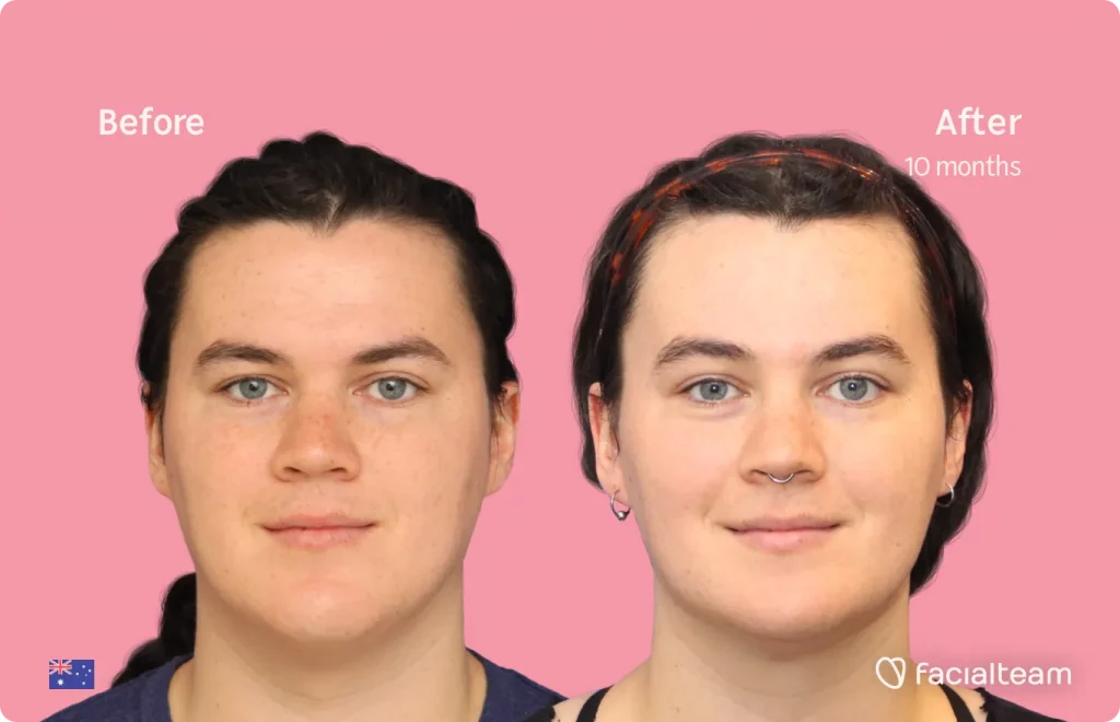 Imagen frontal de la paciente FFS Winter que muestra los resultados antes y después de la cirugía de feminización facial con Facialteam que consiste en la cirugía de feminización de la frente, la mandíbula y el mentón.