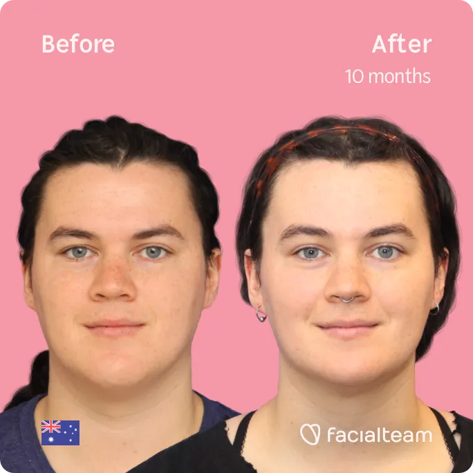 Imagen frontal cuadrada de la paciente FFS Winter que muestra los resultados antes y después de la cirugía de feminización facial con Facialteam que consiste en la cirugía de feminización de la frente, la mandíbula y el mentón.