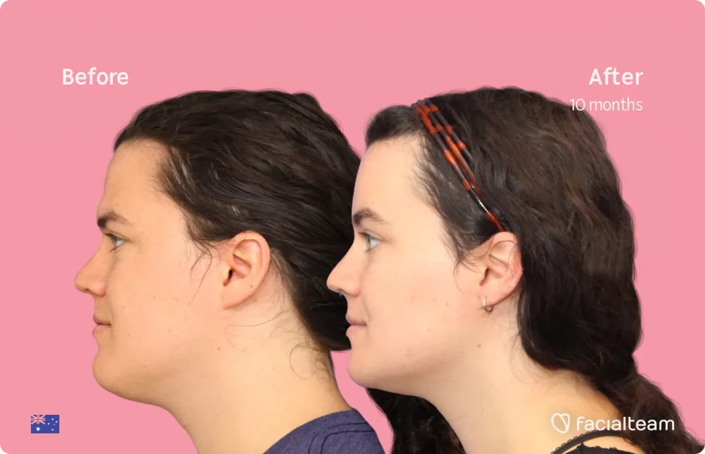 Imagen lateral de la paciente de FFS Winter que muestra los resultados antes y después de la cirugía de feminización facial con Facialteam que consiste en la cirugía de feminización de la frente, la mandíbula y el mentón.