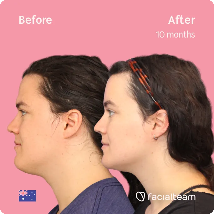 Imagen lateral cuadrada de la paciente FFS Winter que muestra los resultados antes y después de la cirugía de feminización facial con Facialteam que consiste en la cirugía de feminización de la frente, la mandíbula y el mentón.