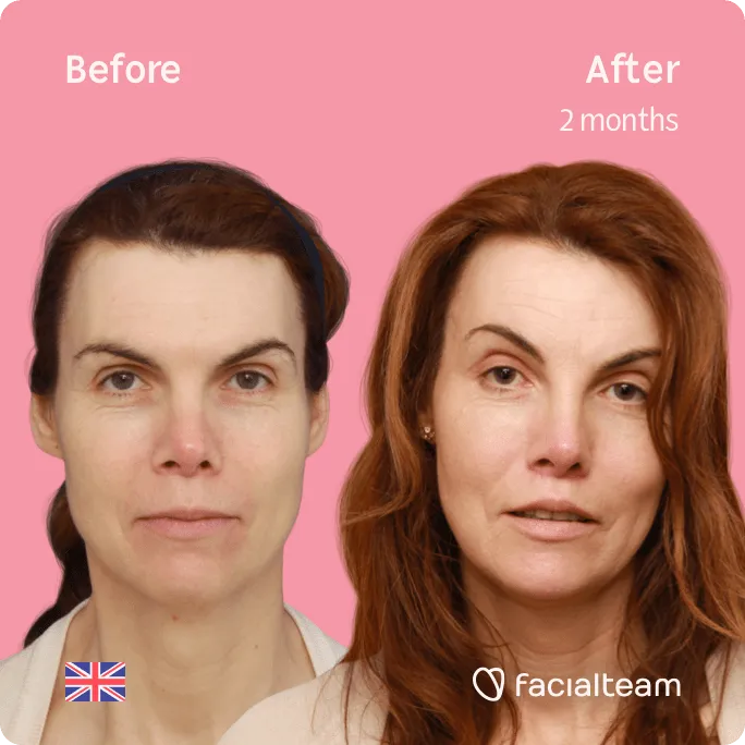Square frontal image of FFS patient Jacqueline G showing the results before and after facial feminization surgery with Facialteam consisting of forehead, jaw and chin, lip feminization surgery.