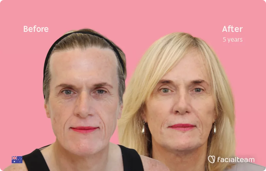 Frontal image of FFS patient Alice showing the results before and after facial feminization surgery with Facialteam consisting of forehead, jaw and chin, rhinoplasty feminization surgery.