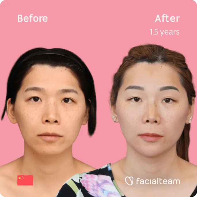 Square frontal image of FFS patient Harriet showing the results before and after facial feminization surgery with Facialteam consisting of forehead, jaw and chin, rhinoplasty feminization surgery.