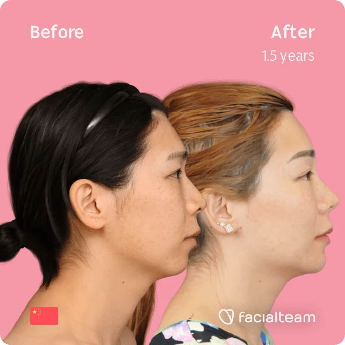 Square Side image of FFS patient Harriet showing the results before and after facial feminization surgery with Facialteam consisting of forehead, jaw and chin, rhinoplasty feminization surgery.