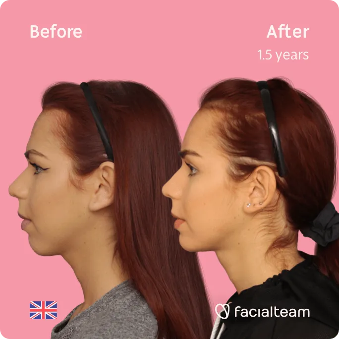 Imagen lateral cuadrada de la paciente Wren de FFS que muestra los resultados antes y después de la cirugía de feminización facial con Facialteam que consiste en la cirugía de feminización de la frente, la mandíbula y la barbilla, con afeitado traqueal.
