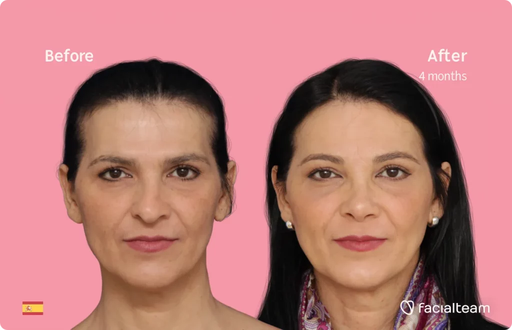 Frontal image of FFS patient Carmen showing the results before and after facial feminization surgery with Facialteam consisting of forehead, rhinoplasty feminization surgery.