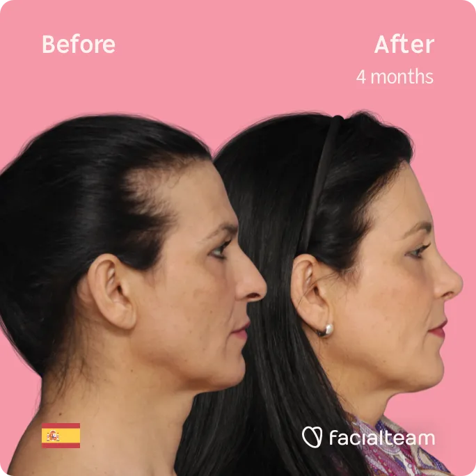 Square Side image of FFS patient Carmen showing the results before and after facial feminization surgery with Facialteam consisting of forehead, rhinoplasty feminization surgery.