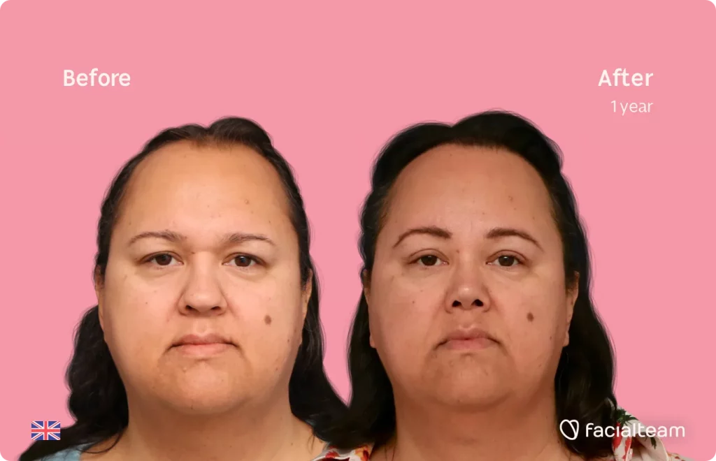 Frontal image of FFS patient Elodie showing the results before and after facial feminization surgery with Facialteam consisting of forehead, rhinoplasty, tracheal shave feminization surgery.