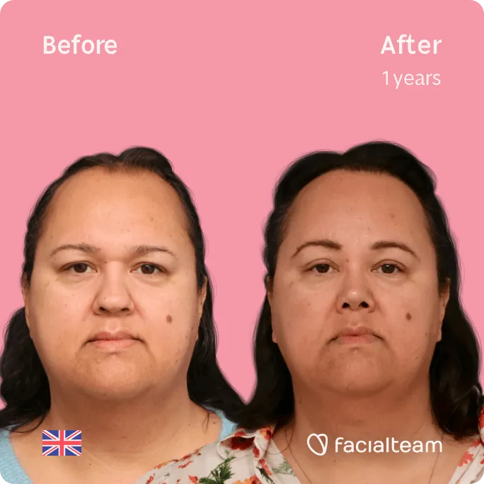 Square frontal image of FFS patient Elodie showing the results before and after facial feminization surgery with Facialteam consisting of forehead, rhinoplasty, tracheal shave feminization surgery.