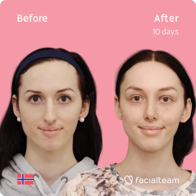 Imagen frontal cuadrada de la paciente de FFS Lise Marie que muestra los resultados antes y después de la cirugía de feminización facial con Facialteam que consiste en cirugía de feminización de la frente, rinoplastia y afeitado traqueal.