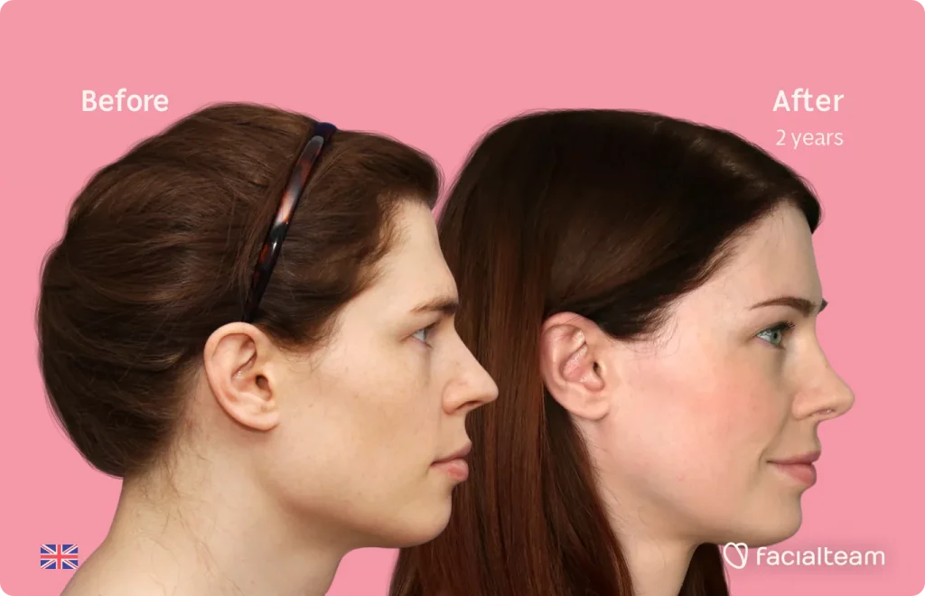 Imagen lateral de la paciente Charlotte W de FFS que muestra los resultados antes y después de la cirugía de feminización facial con Facialteam, que consiste en una cirugía de feminización de la frente, rinoplastia, rasurado traqueal, mandíbula y mentón.