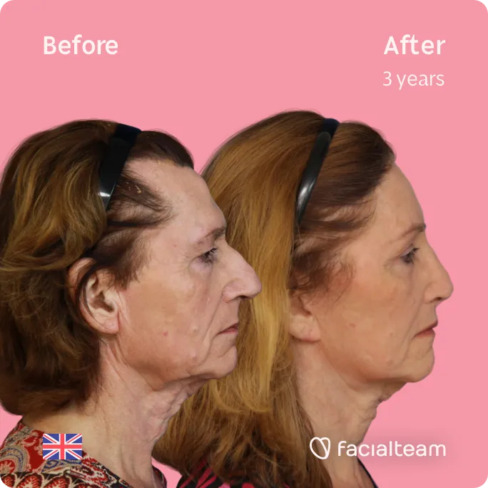 Square Side image of FFS patient Hannah showing the results before and after facial feminization surgery with Facialteam consisting of forehead, rhinoplasty, tracheal shave, lip feminization surgery.