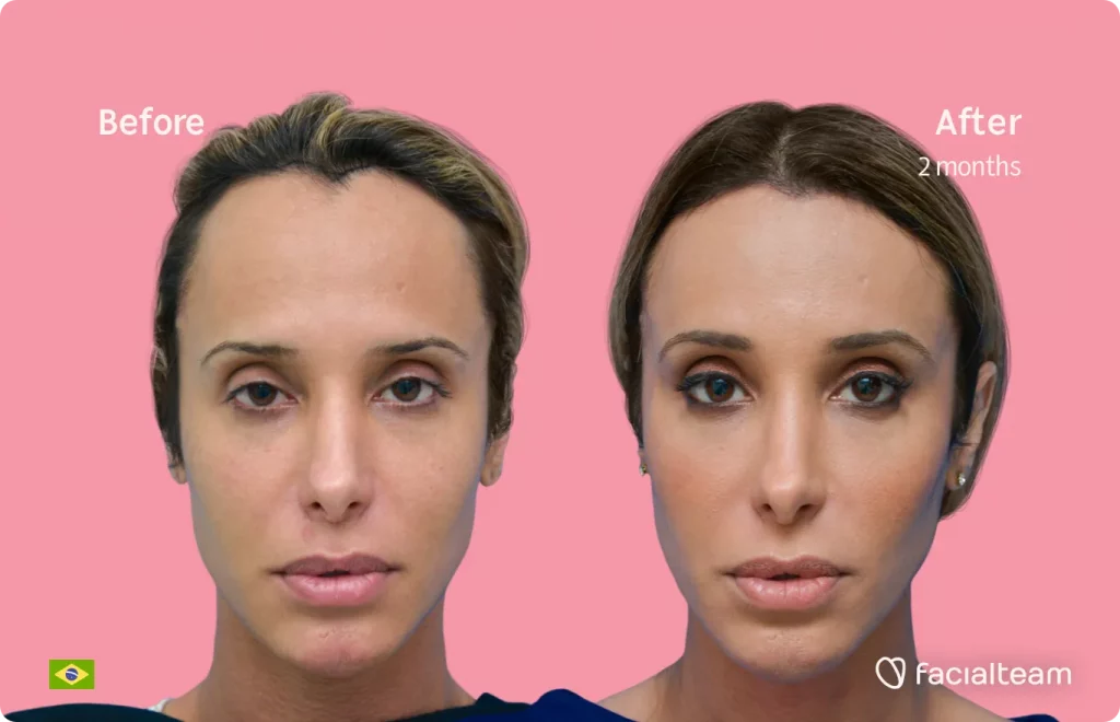 Frontal image of FFS patient Carol showing the results before and after facial feminization surgery with Facialteam consisting of forehead, tracheal shave feminization surgery.