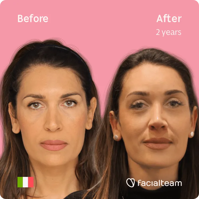 Imagen frontal cuadrada de la paciente Mónica de FFS que muestra los resultados antes y después de la cirugía de feminización facial con Facialteam que consiste en la cirugía de feminización de la frente, afeitado traqueal.