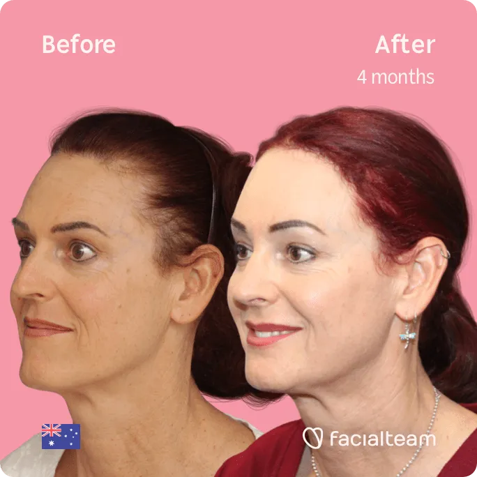 Imagen cuadrada de 45 grados de la paciente Pippa de FFS que muestra los resultados antes y después de la cirugía de feminización facial que consiste en la cirugía de feminización de la mandíbula y el mentón, la frente y la rinoplastia.