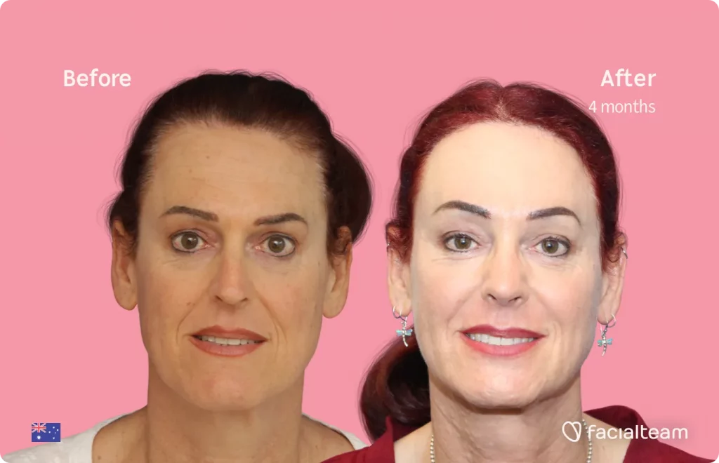 Imagen frontal de la paciente Pippa de FFS que muestra los resultados antes y después de la cirugía de feminización facial con Facialteam que consiste en la cirugía de feminización de la mandíbula y el mentón, la frente y la rinoplastia.