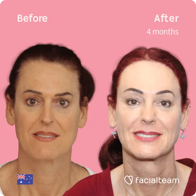 Imagen frontal cuadrada de Pippa, paciente de FFS, que muestra los resultados antes y después de la cirugía de feminización facial con el equipo de mandíbula y mentón, frente y rinoplastia.