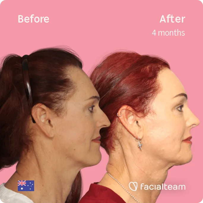 Imagen de lado cuadrado de la paciente Pippa de FFS que muestra los resultados antes y después de la cirugía de feminización facial con Facialteam que consiste en la cirugía de feminización de la mandíbula y el mentón, la frente y la rinoplastia.