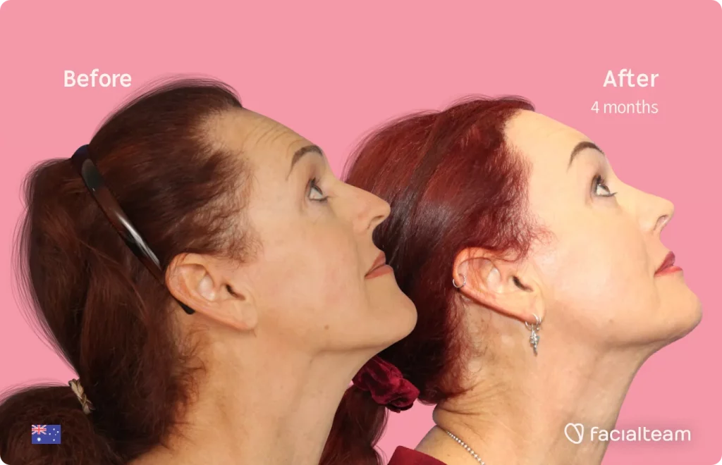 Imagen de lado de la paciente de FFS Pippa que muestra los resultados antes y después de la cirugía de feminización facial con Facialteam que consiste en la cirugía de feminización de la mandíbula y el mentón, la frente y la rinoplastia.