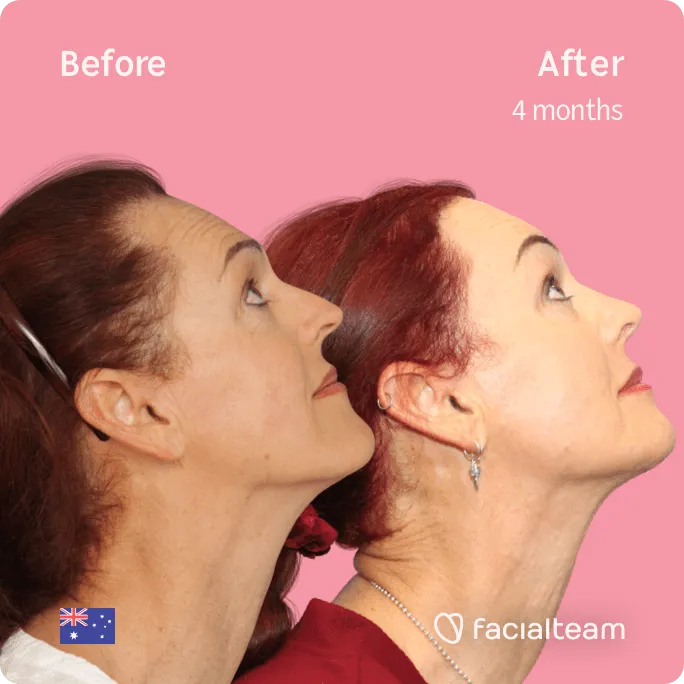 Imagen Square Side up de la paciente Pippa de FFS que muestra los resultados antes y después de la cirugía de feminización facial con Facialteam que consiste en la cirugía de feminización de la mandíbula y el mentón, la frente y la rinoplastia.
