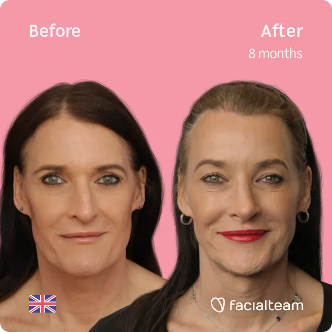 Imagen frontal cuadrada de la paciente Susan de FFS que muestra los resultados antes y después de la cirugía de feminización facial con Facialteam consistente en mandíbula y mentón, rinoplastia, cirugía de feminización de la frente.