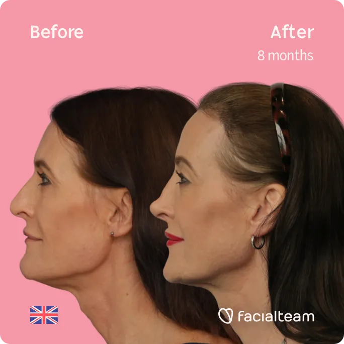 Imagen de lado cuadrado de la paciente Susan de FFS que muestra los resultados antes y después de la cirugía de feminización facial con Facialteam que consiste en mandíbula y mentón, rinoplastia, cirugía de feminización de la frente.