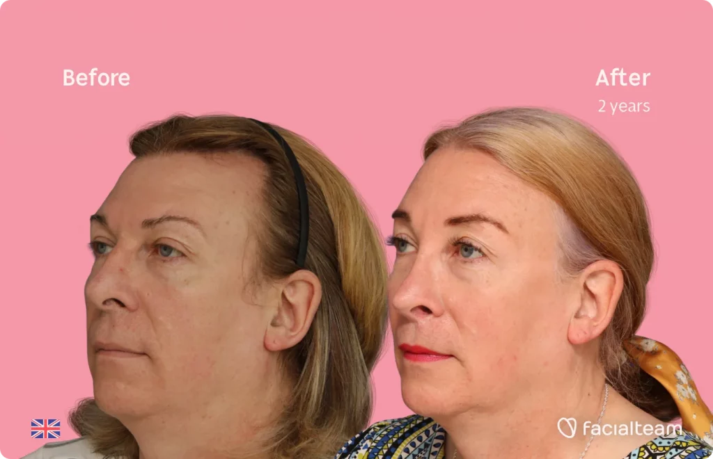 Imagen de 45 grados de la paciente FFS Stephanie que muestra los resultados antes y después de la cirugía de feminización facial que consiste en la rinoplastia, la frente, el afeitado de la tráquea y la cirugía de feminización de los labios.