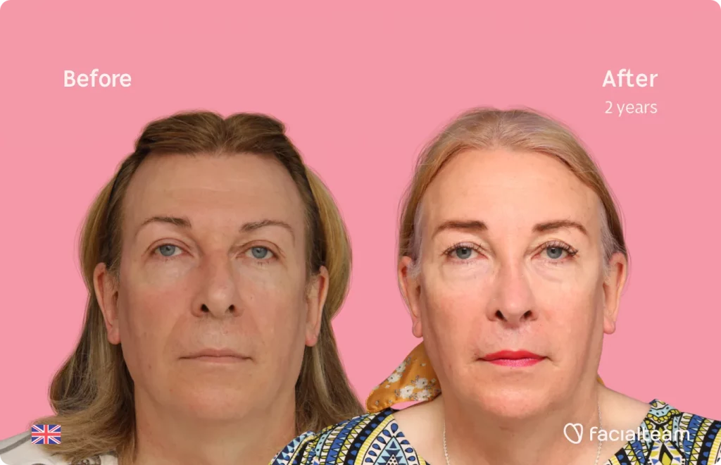 Imagen frontal de la paciente de FFS Stephanie que muestra los resultados antes y después de la cirugía de feminización facial con Facialteam que consiste en rinoplastia, frente, rasurado traqueal, cirugía de feminización de labios.
