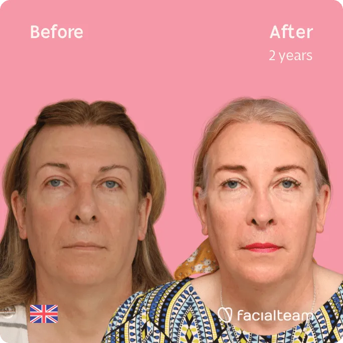Imagen frontal cuadrada de la paciente FFS Stephanie que muestra los resultados antes y después de la cirugía de feminización facial con Facialteam que consiste en rinoplastia, frente, rasurado traqueal, cirugía de feminización de labios.