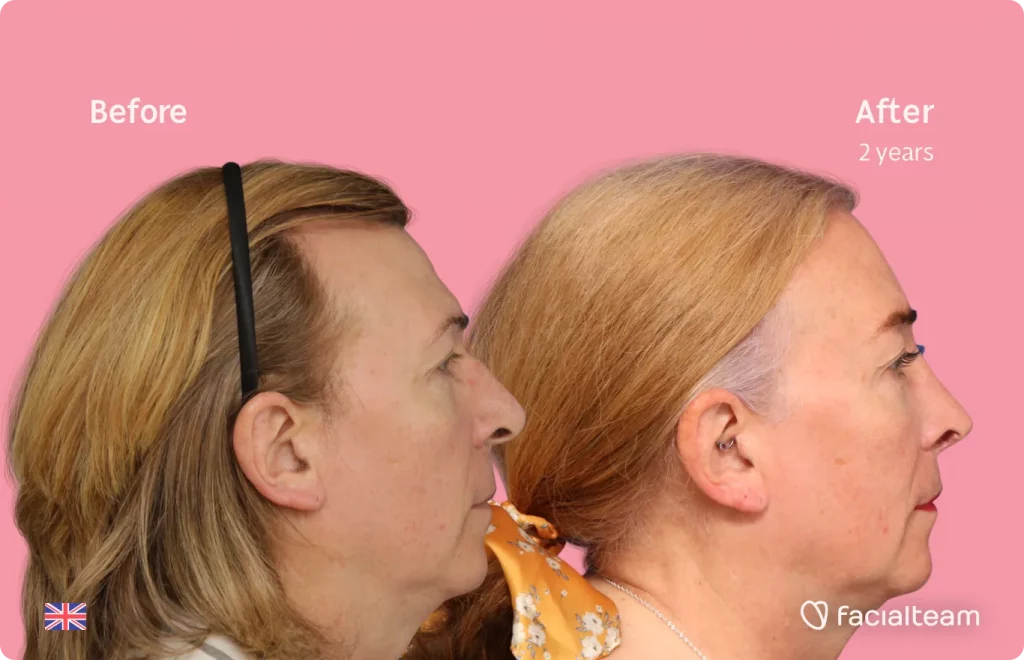 Imagen lateral de la paciente de FFS Stephanie que muestra los resultados antes y después de la cirugía de feminización facial con Facialteam que consiste en rinoplastia, frente, rasurado traqueal, cirugía de feminización de labios.