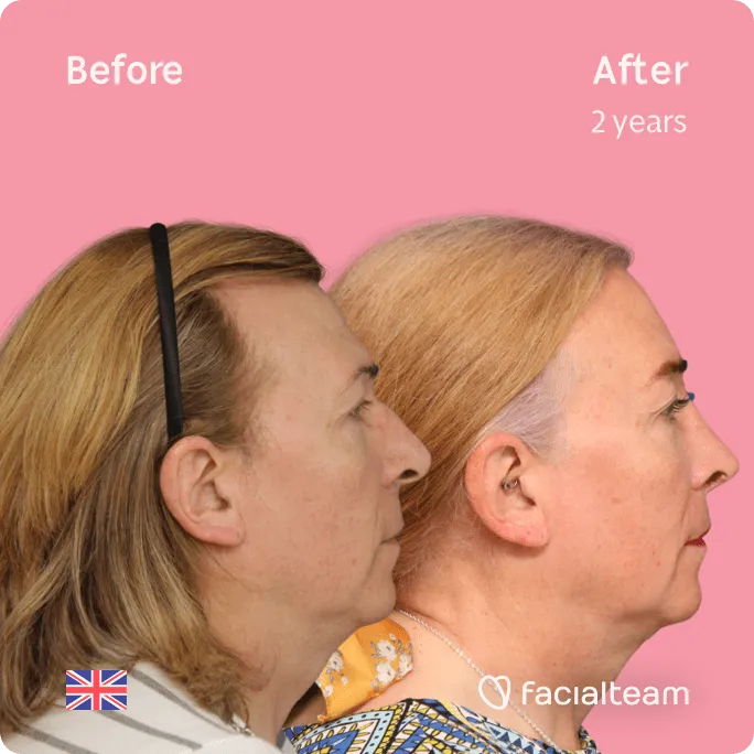 Imagen lateral cuadrada de la paciente FFS Stephanie que muestra los resultados antes y después de la cirugía de feminización facial con Facialteam que consiste en rinoplastia, frente, rasurado traqueal, cirugía de feminización de labios.