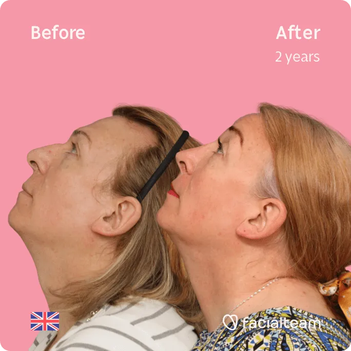 Imagen cuadrada de la paciente Stephanie de FFS que muestra los resultados antes y después de la cirugía de feminización facial con Facialteam que consiste en rinoplastia, frente, rasurado traqueal, cirugía de feminización de labios.