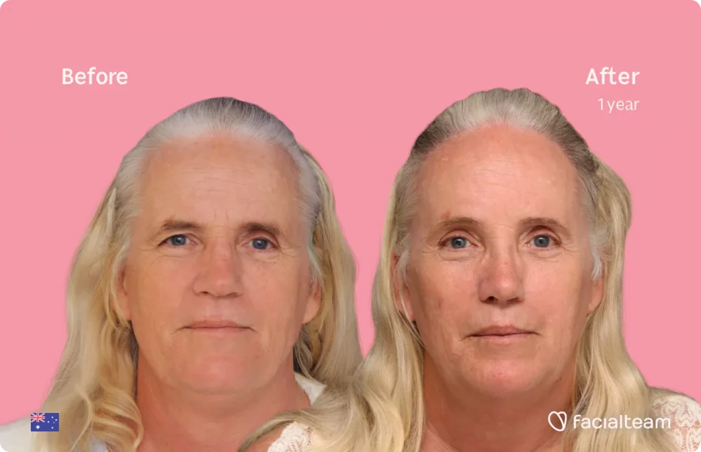 Imagen frontal de la paciente Sarah C de FFS que muestra los resultados antes y después de la cirugía de feminización facial con Facialteam que consiste en rinoplastia, rasurado traqueal, cirugía de feminización de la frente, la mandíbula y el mentón.