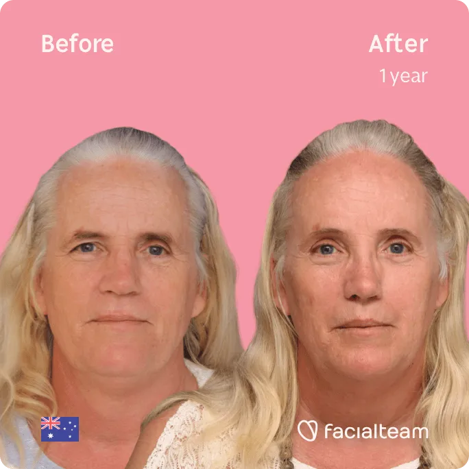 Imagen frontal cuadrada de la paciente Sarah C de FFS que muestra los resultados antes y después de la cirugía de feminización facial con Facialteam que consiste en rinoplastia, rasurado traqueal, cirugía de feminización de la frente, la mandíbula y el mentón.