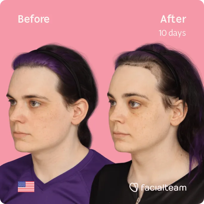 Imagen cuadrada de 45 grados de Téa, paciente de FFS, que muestra los resultados antes y después de la cirugía de feminización facial que consiste en el afeitado traqueal, la cirugía de feminización de la frente, la mandíbula y el mentón.