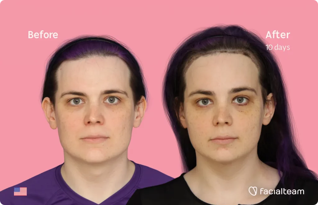 Imagen frontal de Téa, paciente de FFS, que muestra los resultados antes y después de la cirugía de feminización facial con Facialteam, que consiste en afeitado traqueal, cirugía de feminización de la frente, la mandíbula y el mentón.