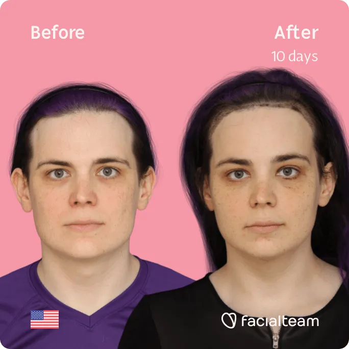 Imagen frontal cuadrada de Téa, paciente de FFS, que muestra los resultados antes y después de la cirugía de feminización facial con Facialteam, que consiste en afeitado traqueal, cirugía de feminización de la frente, la mandíbula y el mentón.