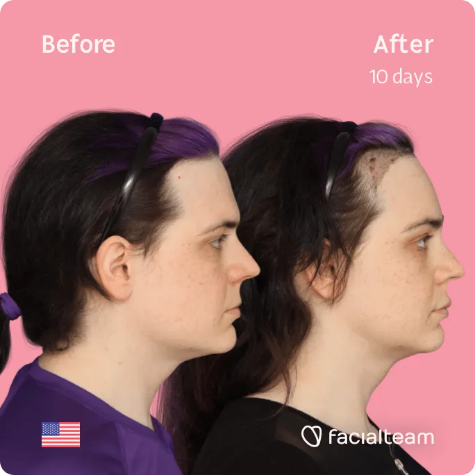 Imagen lateral cuadrada de Téa, paciente de FFS, que muestra los resultados antes y después de la cirugía de feminización facial con Facialteam, que consiste en afeitado traqueal, cirugía de feminización de la frente, la mandíbula y el mentón.